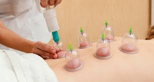 CUPPING THERAPY