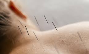 ACUPUNCTURE
